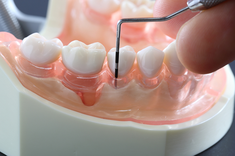 歯ぐきの検査（プロービング）