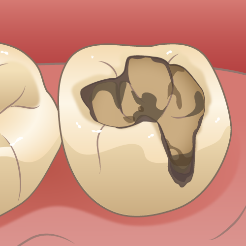 治療済みの歯が再び虫歯になる（二次虫歯）