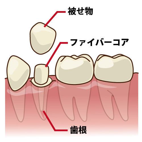 セラミック治療の際におすすめの土台（ファイバーコア）