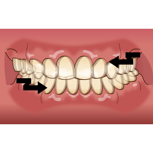 食いしばり・歯ぎしりはセラミックの寿命を縮めます