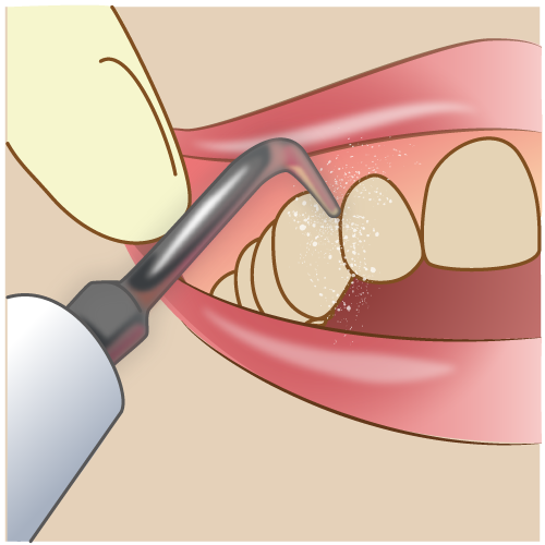 歯石と歯垢（プラーク）はどう違う？