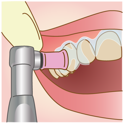 ホワイトニング前のクリーニング